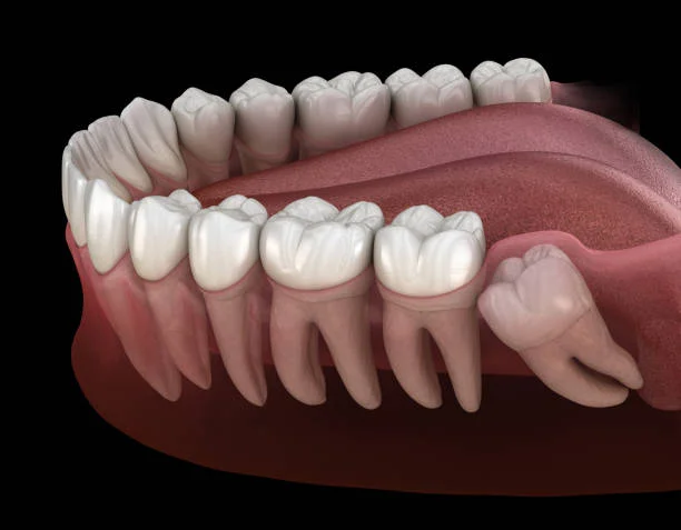 Best Wisdom Tooth Removal in Bhayandar, Mumbai
